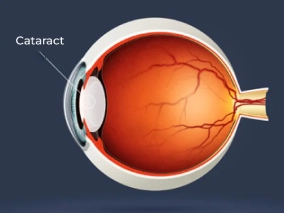 Cataract