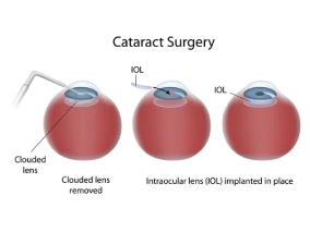 Cataract