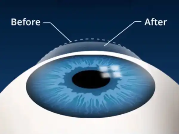 Lasik Treatment