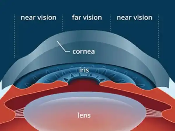 Lasik Treatment