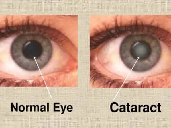 Normal Eye Cataract