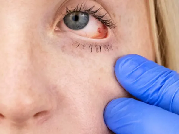 Uveitis Symptoms Uveitis